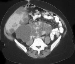 Polycystic Liver and Kidney Disease - CTisus CT Scan