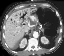 Portal Venous Air Secondary to G-tube Placement - CTisus CT Scan