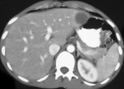 Aspergillosis Liver (AIDS Patient) - CTisus CT Scan