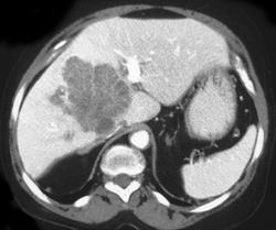 Inflammatory Pseudotumor Liver - CTisus CT Scan