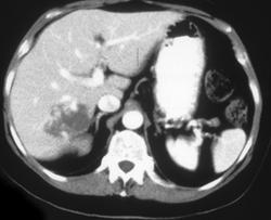 Hemangioma - CTisus CT Scan