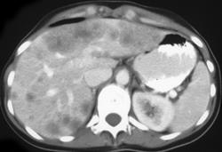 Liver Metastases-breast Cancer - CTisus CT Scan