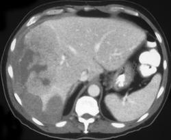 Hepatoma That Bled Spontaneously With Rupture of the Liver Capsule - CTisus CT Scan