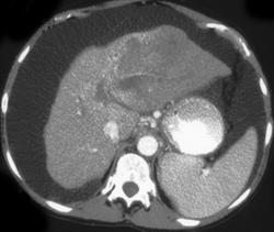 Hepatoma - CTisus CT Scan