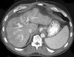 Hepatoma-hypervascular - CTisus CT Scan