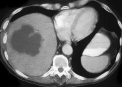 Liver Abscess - CTisus CT Scan