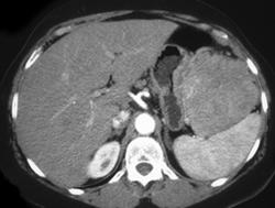 Hepatoma Off Left Lobe of Liver Simulating A Gastric Mass - CTisus CT Scan