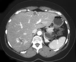 Hemangioma - CTisus CT Scan