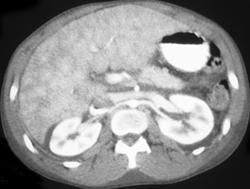 Cardiac Cirrhosis Secondary Right Sided Heart Failure and Huge Pericardial Effusion. - CTisus CT Scan