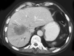 Cholangiocarcinoma - CTisus CT Scan