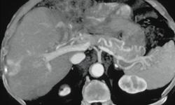 Flow Changes Around A Biliary Catheter - CTisus CT Scan