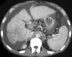 Hepatoma in A Cirrhotic Liver (dual Phase) - CTisus CT Scan