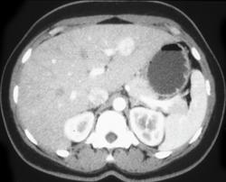 Focal Nodular Hyperplasia (dual Phase) - CTisus CT Scan