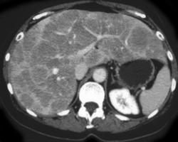 Metastatic Carcinoid Tumor to Liver - CTisus CT Scan