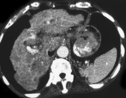 Cirrhosis With Multifocal Hepatoma - CTisus CT Scan