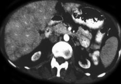 Cirrhosis - CTisus CT Scan