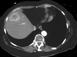 Hypervascular Cholangiocarcinoma - CTisus CT Scan