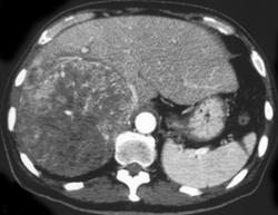 Hepatoma - CTisus CT Scan