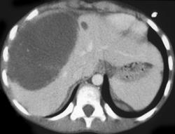 Mesenchymal Sarcoma of the Liver - CTisus CT Scan