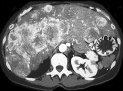 Carcinoid Metastatic to Liver (dual Phase) - CTisus CT Scan