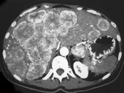 Hepatitis C W/cirrhosis - CTisus CT Scan