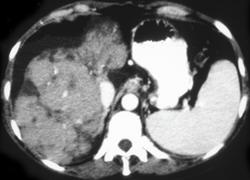 Hemangioma - CTisus CT Scan