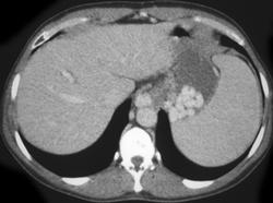 Hepatoma - CTisus CT Scan