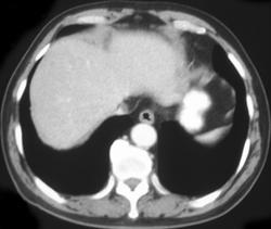 Lymphoma Involves the Liver - CTisus CT Scan