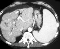 Lymphoma W/hepatic Involvement - CTisus CT Scan