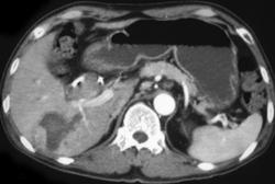 Hepatoma Seen Best on Portal Phase - CTisus CT Scan