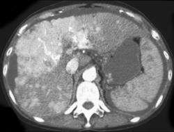 Focal Nodular Hyperplasia (FNH) - CTisus CT Scan