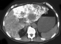 Emphysematous Cholecystitis - CTisus CT Scan