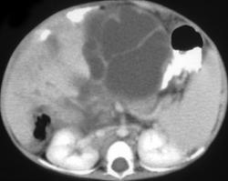 Pseudo-cirrhosis in Patient W/treated Metastases in Breast Cancer - CTisus CT Scan