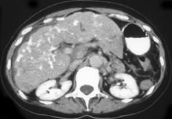 Hepatoma - CTisus CT Scan