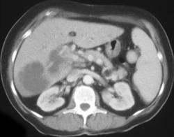 Varices Seen Best on Portal Phase - CTisus CT Scan