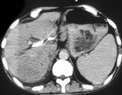 Portal Vein Thrombosis - CTisus CT Scan