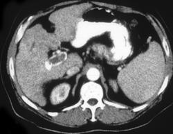 Hepatoma W/implants on the Spleen - CTisus CT Scan