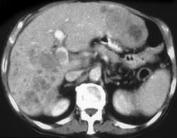 Inflammatory Pseudotumor - CTisus CT Scan