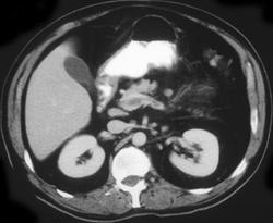 Cirrhosis W/varices - CTisus CT Scan