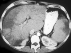 Hepatoma - CTisus CT Scan