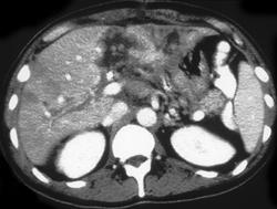 Colon Cancer Metastatic to Liver - CTisus CT Scan