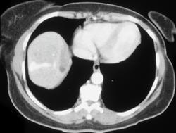 Portal Vein Thrombosis & Cirrhosis - CTisus CT Scan