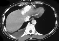 Hepatoma - CTisus CT Scan