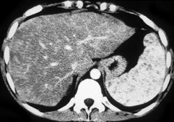 Hemangioma - CTisus CT Scan