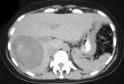 Hepatoma - CTisus CT Scan