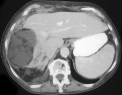 Hepatic Infarcts - CTisus CT Scan