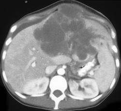 Renal Cell Carcinoma Metastatic to the Liver - CTisus CT Scan