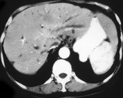 Cavernous Transformation of the Portal Vein - CTisus CT Scan