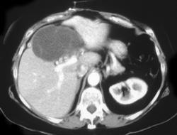 Giant Hemangioma - CTisus CT Scan