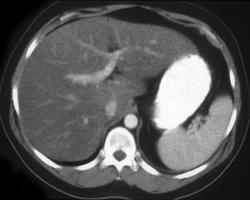 Vascular Liver Metastases - CTisus CT Scan